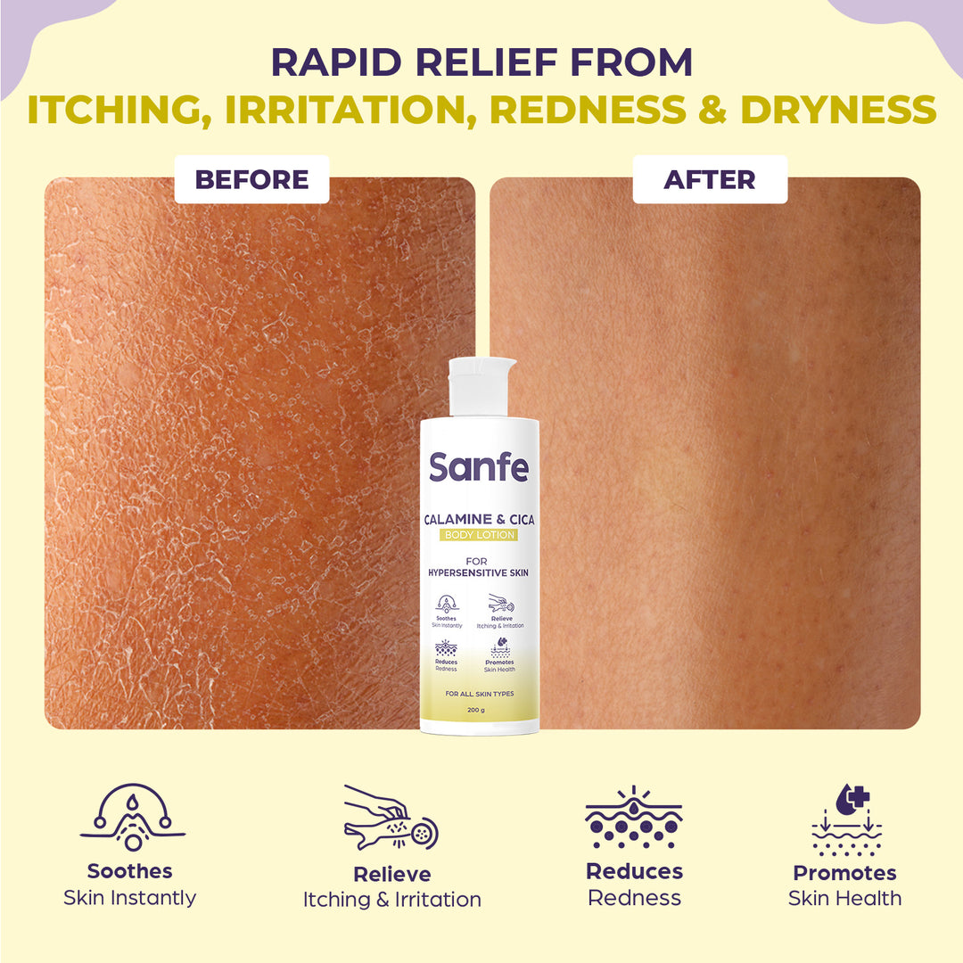 -Sanfe Calamine Body Lotion - 200ml