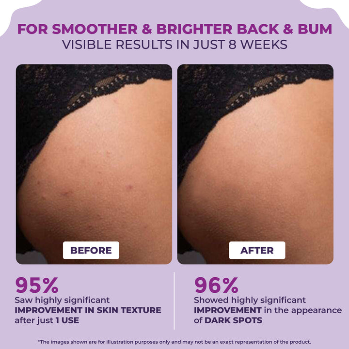 Back and Bum lightening Cream - 100gm