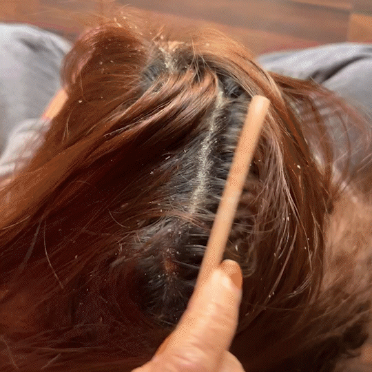 Instant Dandruff Removal Gel