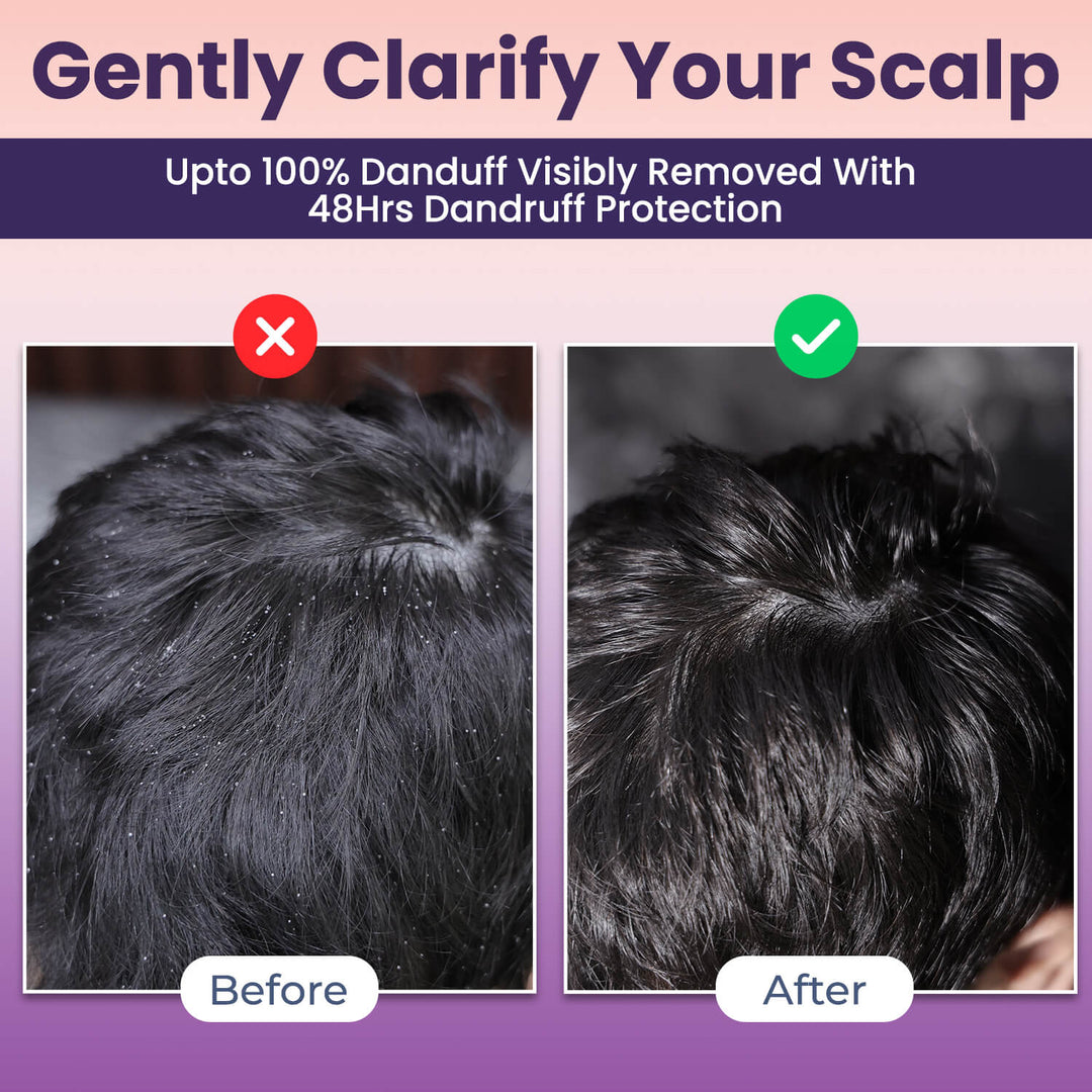 Instant Dandruff Removal Gel