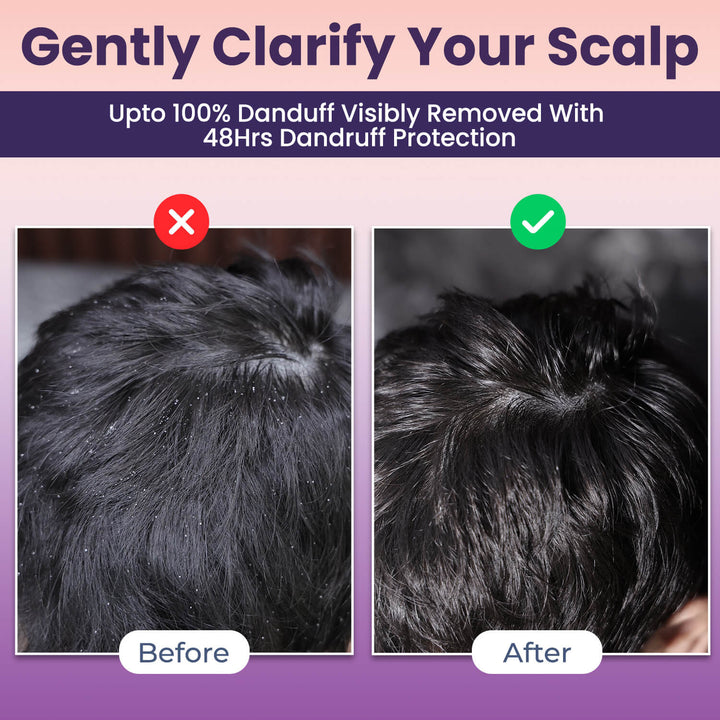 Instant Dandruff Removal Gel