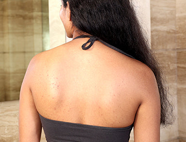 Guide To Less Known - Back & Bum Acne