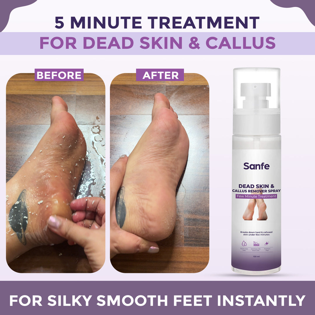 Sanfe Dead Skin & Callus Remover Spray - 100ml