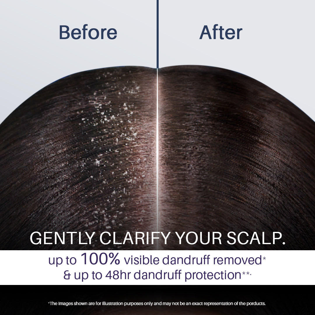 Instant Dandruff Removal Gel