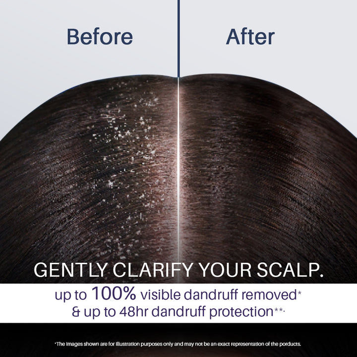 Instant Dandruff Removal Gel