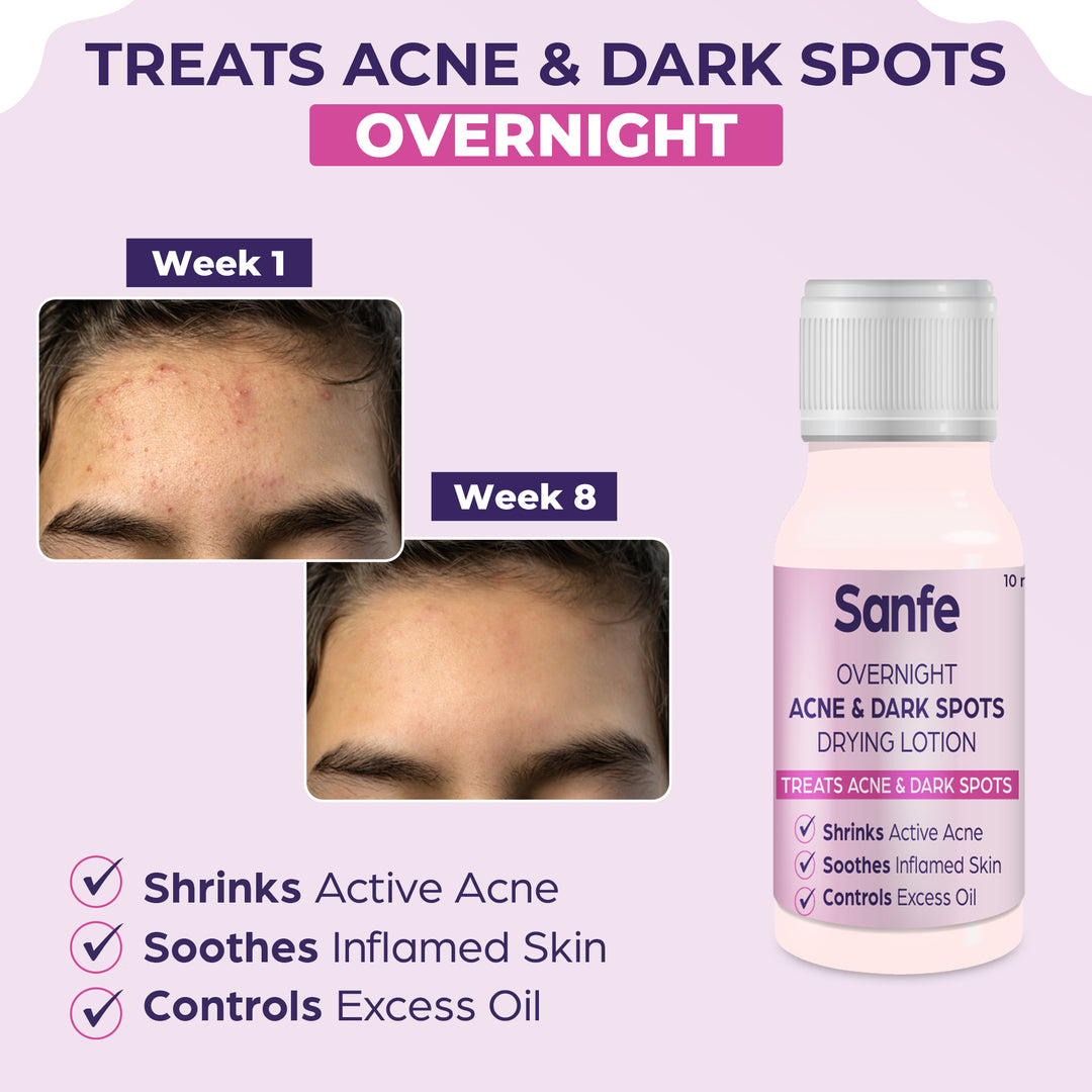 Sanfe Overnight Acne & Dark Spots Drying Lotion - 10ml