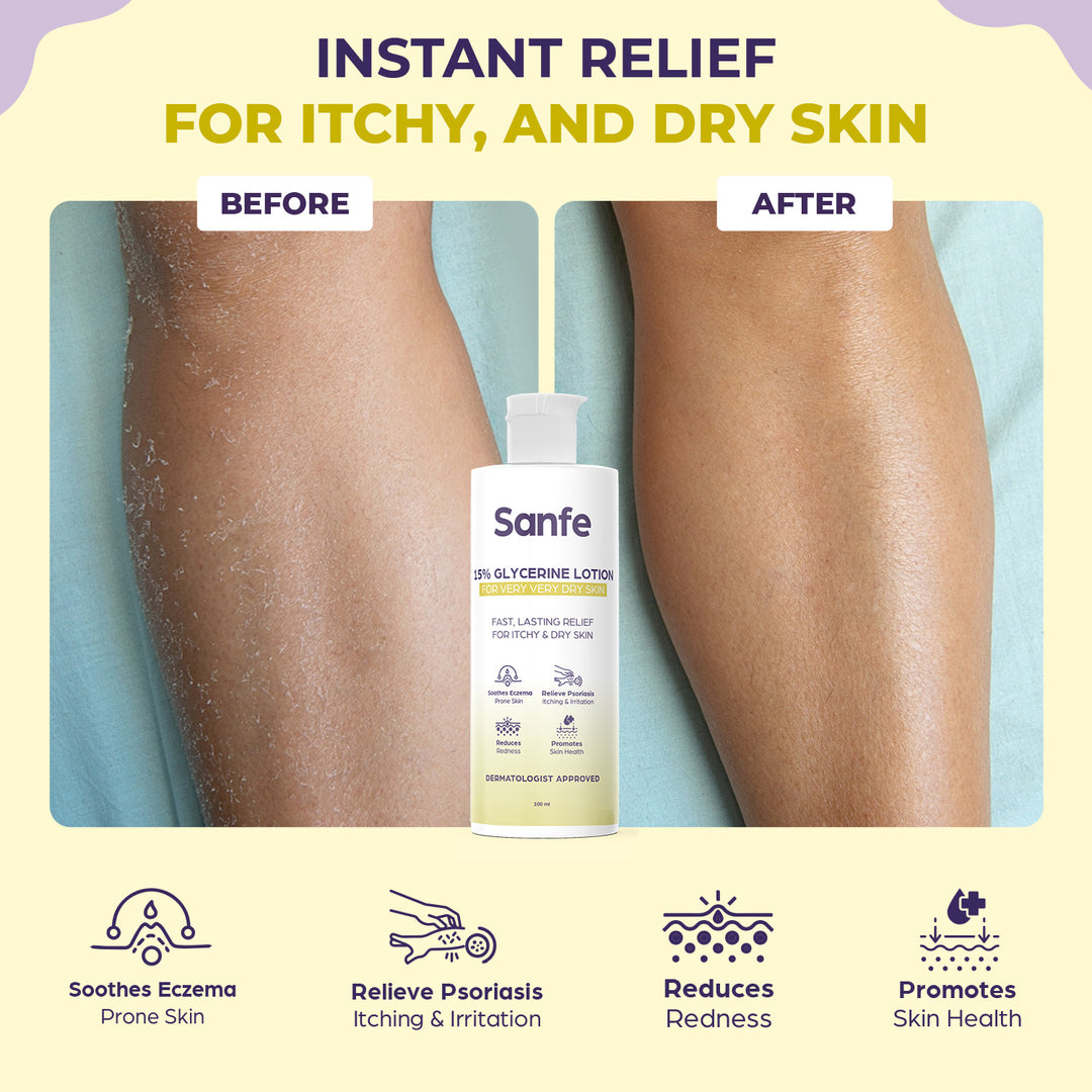 Sanfe Eczema Lotion - 100ml