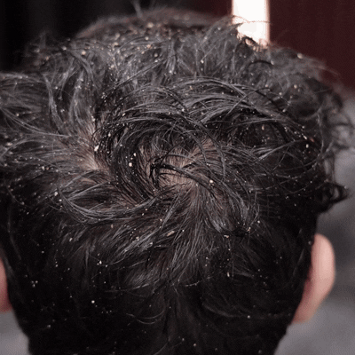 Instant Dandruff Removal Gel