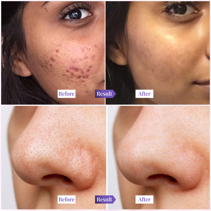 Sanfe Acne & Blackhead Clear Combo