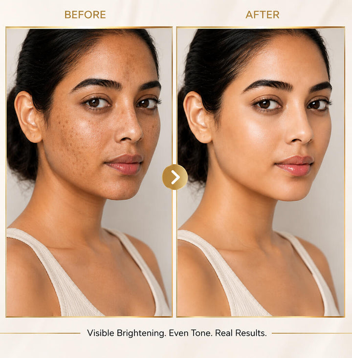 Sanfe PigmentReset 5 Day Melasma Cure Kit