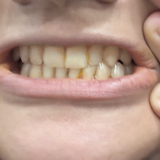Purple Teeth Whitening Gel