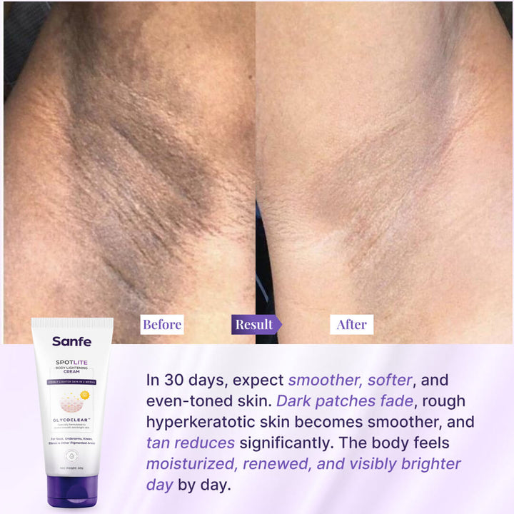 Spotlite Body Lightening Cream