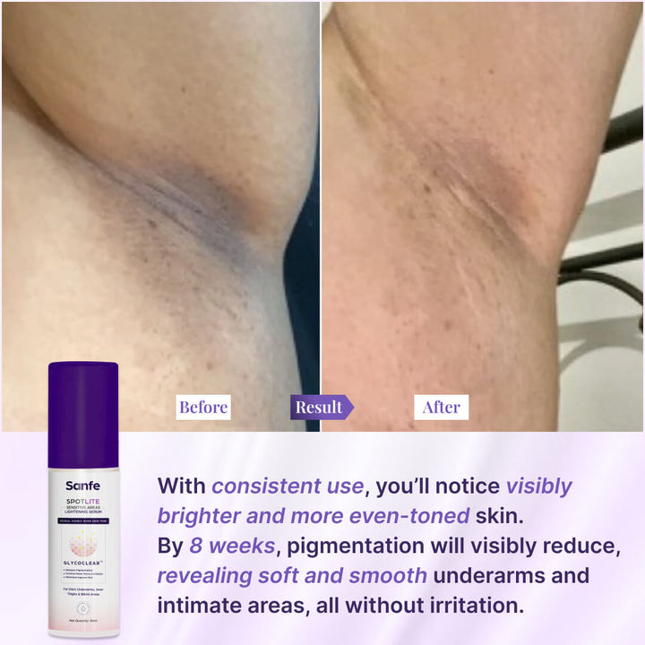 Spotlite Sensitive Areas Lightening Serum For Women