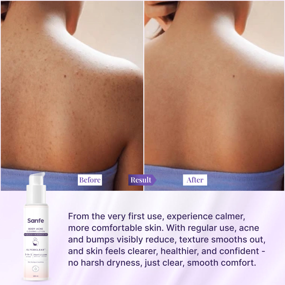Sanfe Body Acne Clearing Lotion 100ml