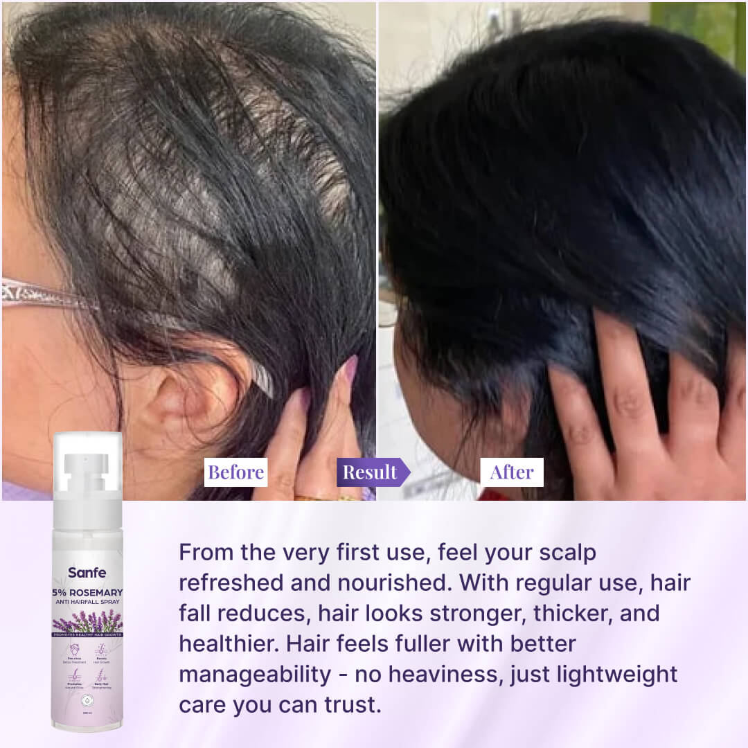 Sanfe 5% Rosemary Anti Hairfall Spray - 100ml