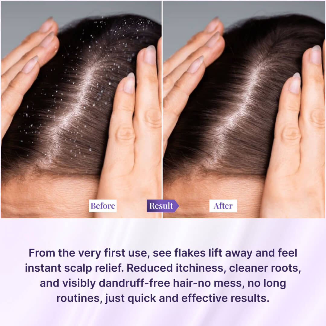 Instant Dandruff Removal Gel