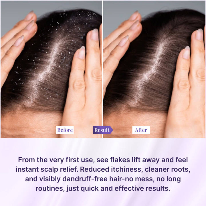 Instant Dandruff Removal Gel