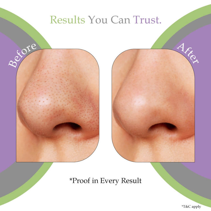 Sanfe Aloe Vera 3 Step Nose Kit