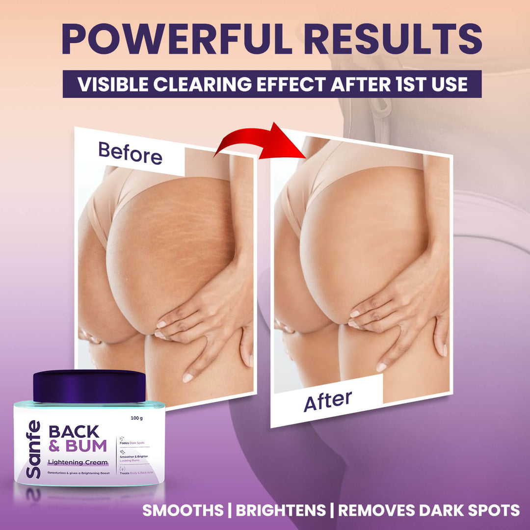 Back and Bum lightening Cream - 100gm