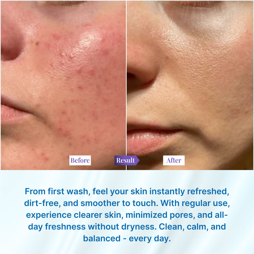 Sanfe Oily Skin Cleanser - 100ml