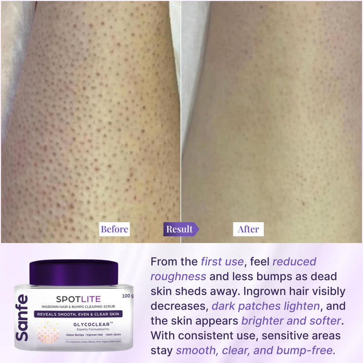 Spotlite Sensitive Areas Body Scrub - Pack of 2