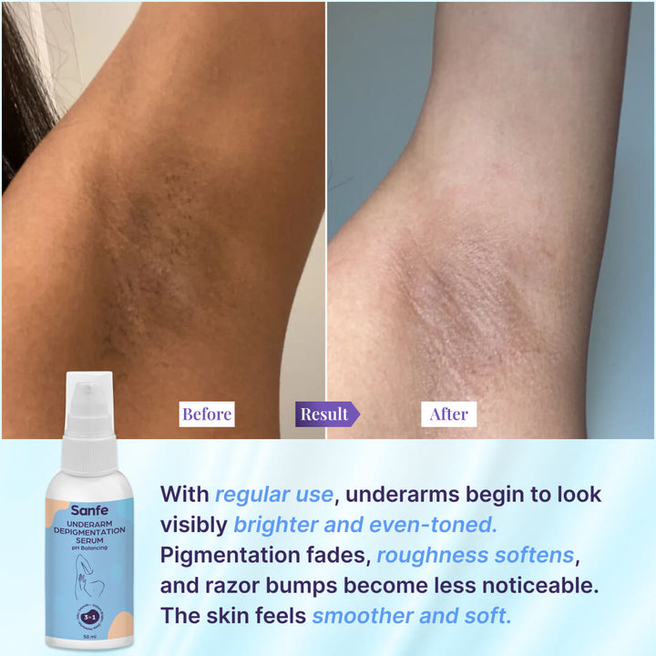 Sanfe Underarm Depigmentation Serum 50ml